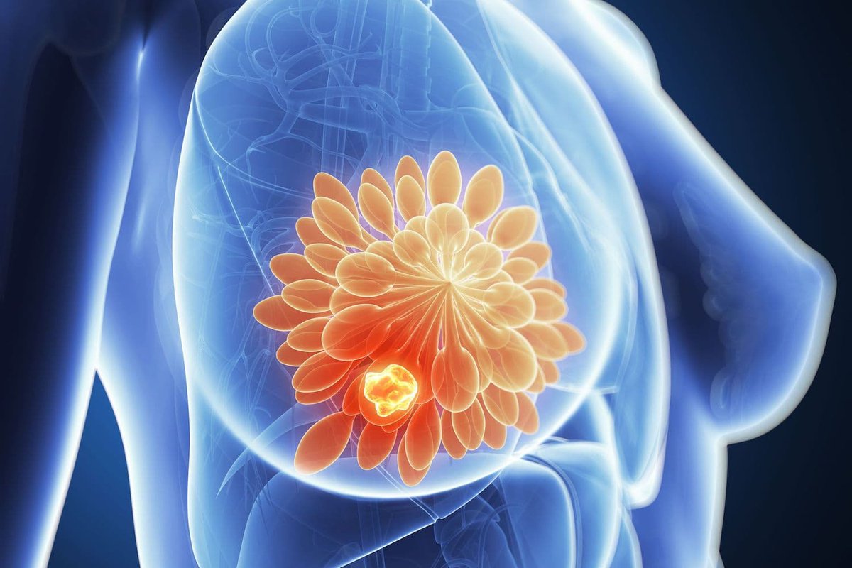 Breast Cancer: 90% Of Cases Can Be Cured If Detected Early